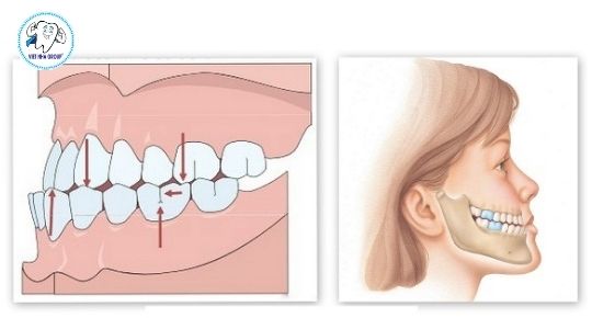 Cách điều trị Răng móm – Khớp cắn ngược tại Nha khoa Việt Nha