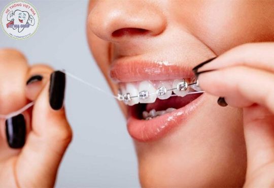 Chăm sóc răng miệng trong quá trình chỉnh nha