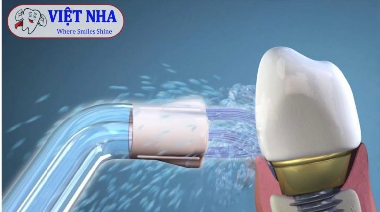 Máy tăm nước – Lựa chọn hoàn hảo cho chăm sóc răng miệng trong quá trình chỉnh nha