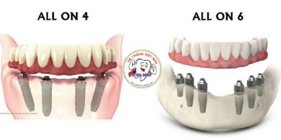 Kỹ thuật trồng răng Implant