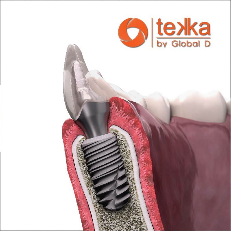 Implant Tekka