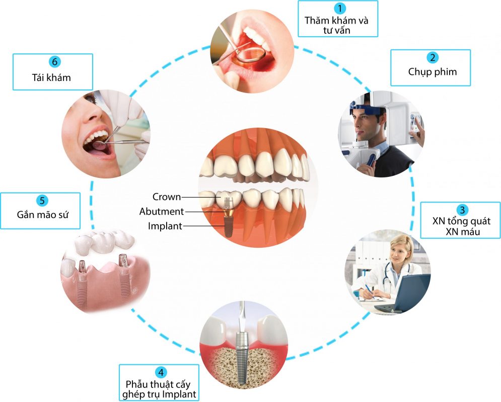 Sự khác nhau giữa Trồng răng Implant và Trồng răng sứ