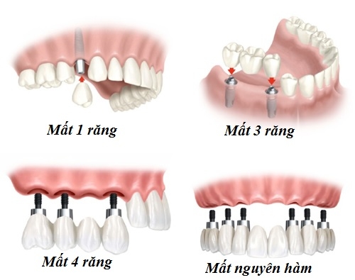 Sự khác nhau giữa Trồng răng Implant và Trồng răng sứ