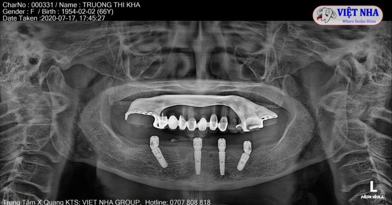 Trồng răng Implant ở đâu
