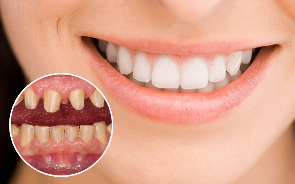 Loại răng sứ phổ biến