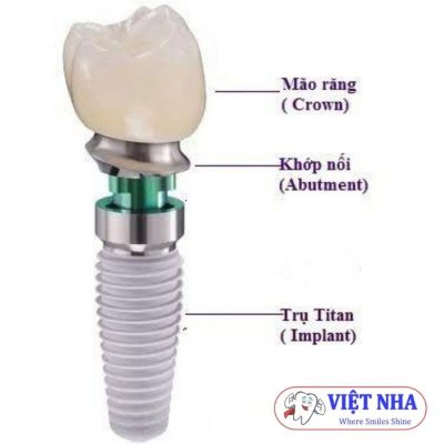 Cấu tạo của 1 răng Implant