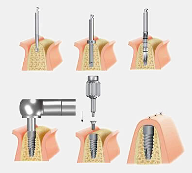 Quy trình cấy ghép Implant
