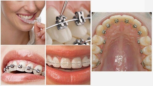 Quá trình niềng răng