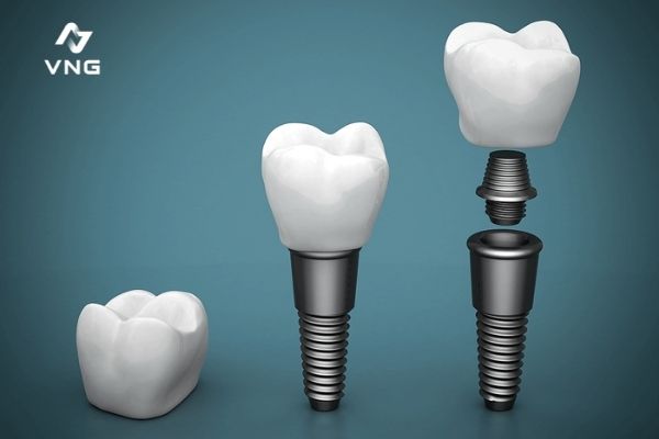 Implant vùng răng cửa