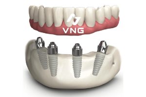 Trụ Implant All On 4 
