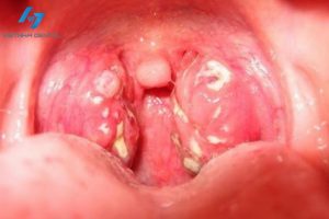 Viêm amidan tạo nên các hốc mủ, dễ gây nhiễm trùng nướu răng và gây mùi hôi miệng