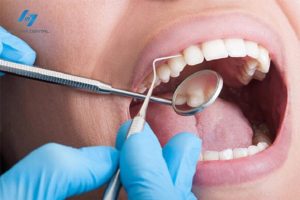 Lấy cao răng ít nhất 6 tháng một lần để đảm bảo sức khỏe răng miệng