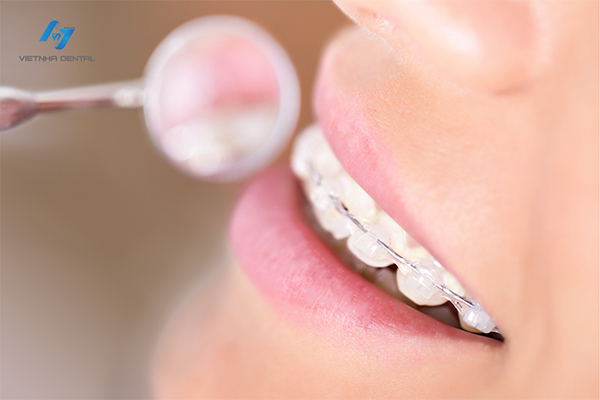 Cắm Trụ Implant Có Được Niềng Răng Không?