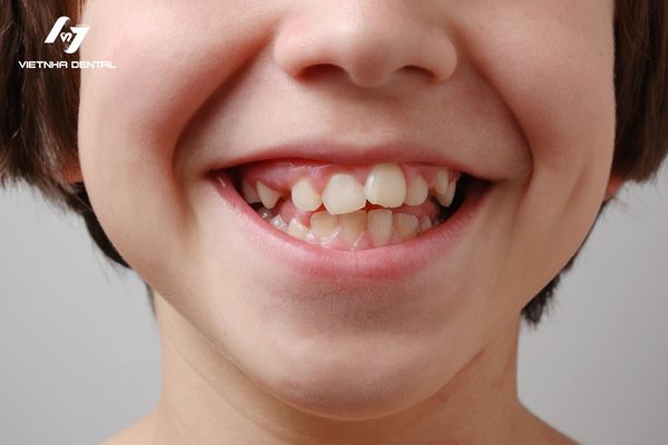 Có nên cho trẻ niềng răng từ sớm?