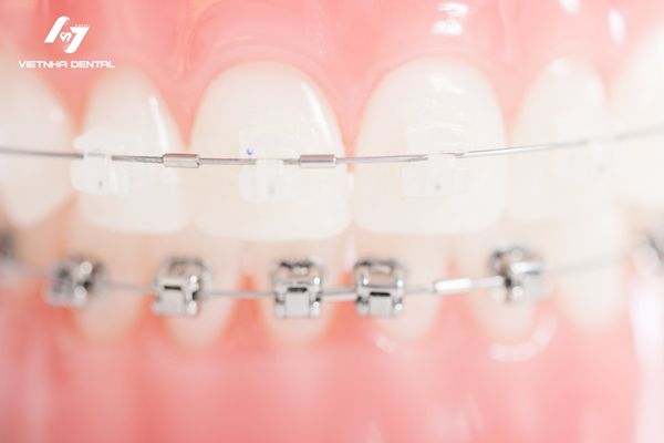 Có nên cho trẻ niềng răng từ sớm?