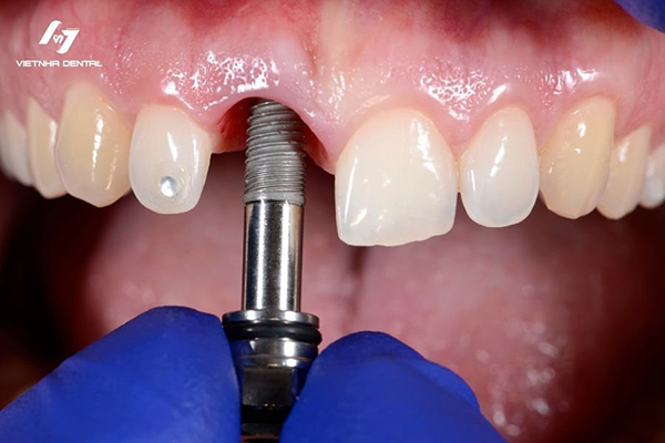 Trồng răng Implant là giải pháp nha khoa thẩm mỹ cực kỳ hiệu quả