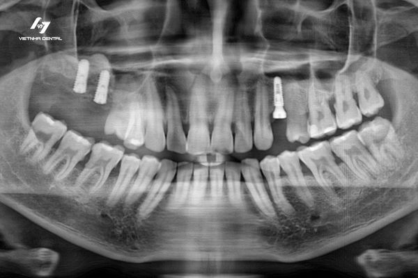 7 Điều Cần Lưu Ý Trước Khi Trồng Răng Implant