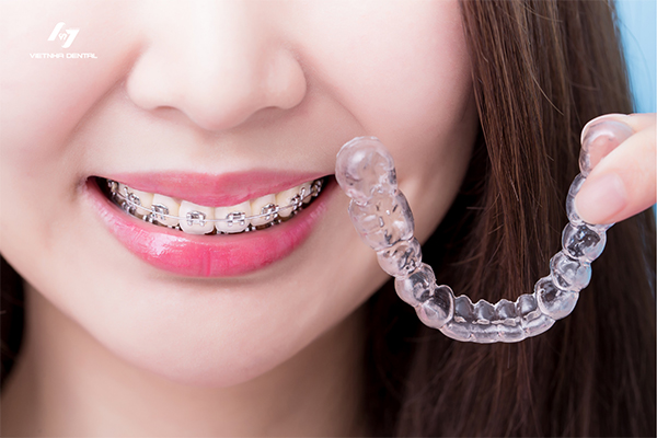 Tổng quan về quy trình niềng răng tại Nha khoa Việt Nha Tân Bình
