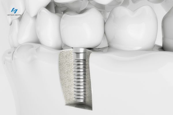 Trồng Răng Implant Có Đau Không? Cách Giảm Đau