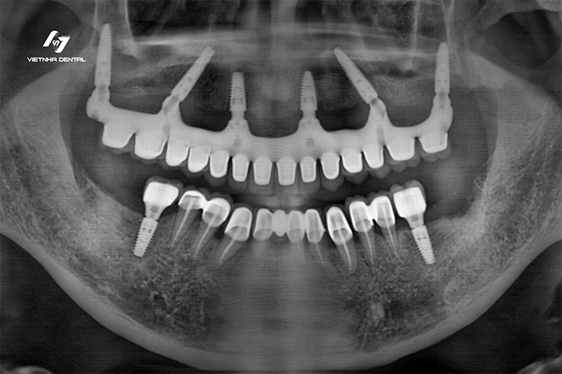 Bảng giá trồng răng Implant toàn hàm