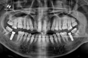 Chụp X-quang răng có ảnh hưởng đến sức khỏe không