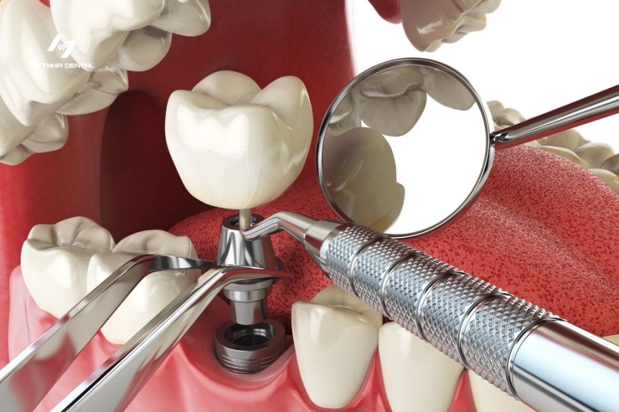 Ưu - Nhược Điểm Của Trồng Răng Implant Bạn Cần Biết