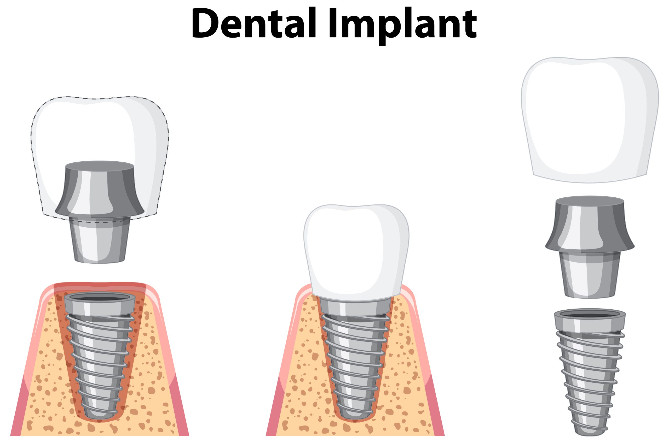 Trụ Implant