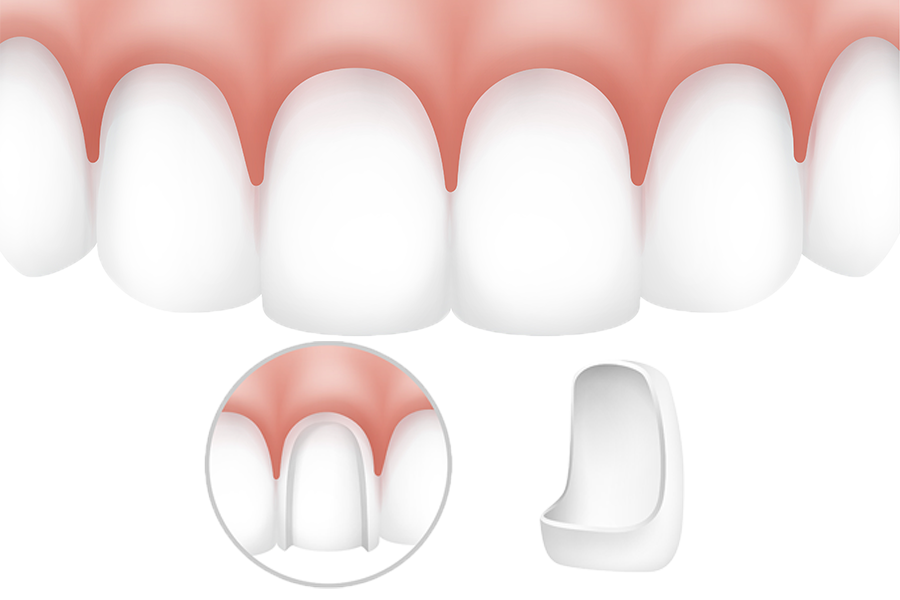 Trồng răng sứ thẩm mỹ có ưu điểm gì?